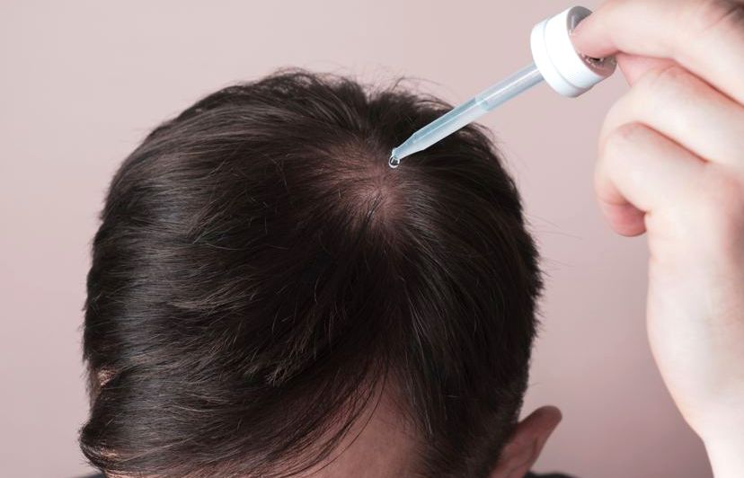 Applying a topical minoxidil and finasteride solution to the scalp with a dropper